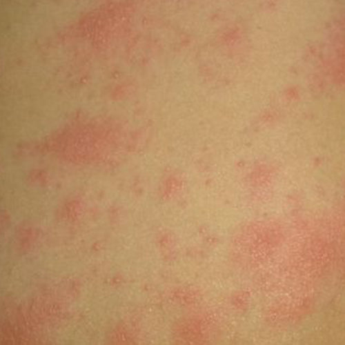 Rashes Associated with COVID-19