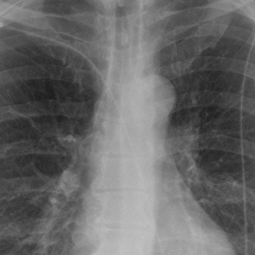 Studies Suggest Chest X-rays May Fight COVID-19