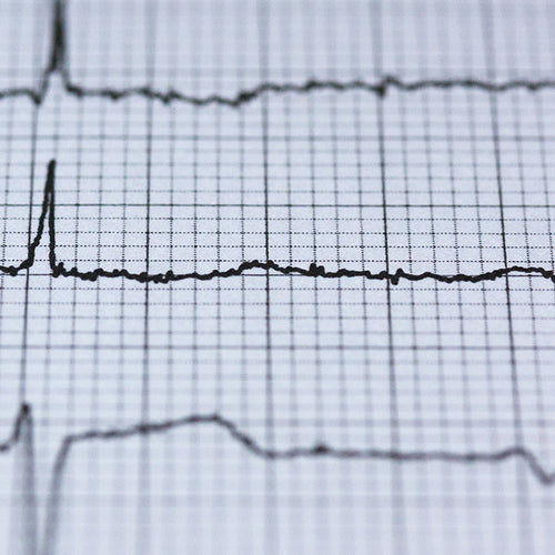 Broken Heart Syndrome On the Rise