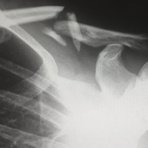 Low Bone Density Linked to Bad Heart Health